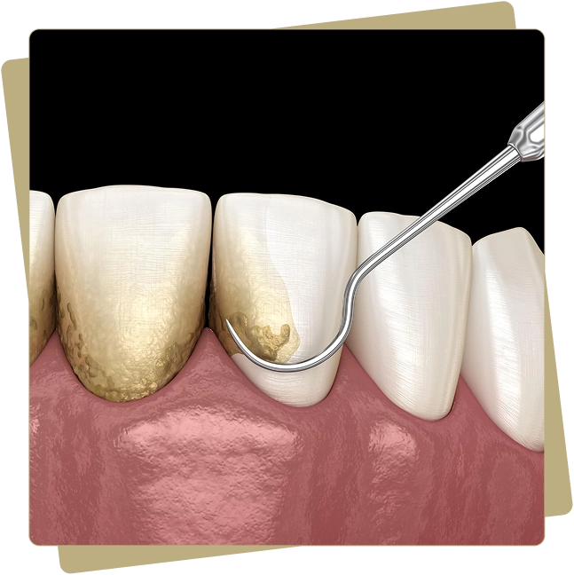 Periodontal Disease