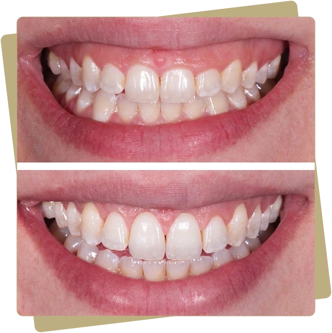 Crown Lengthening